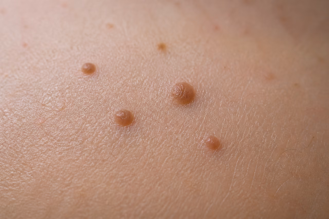 Close Up of Raised Moles Under Skin