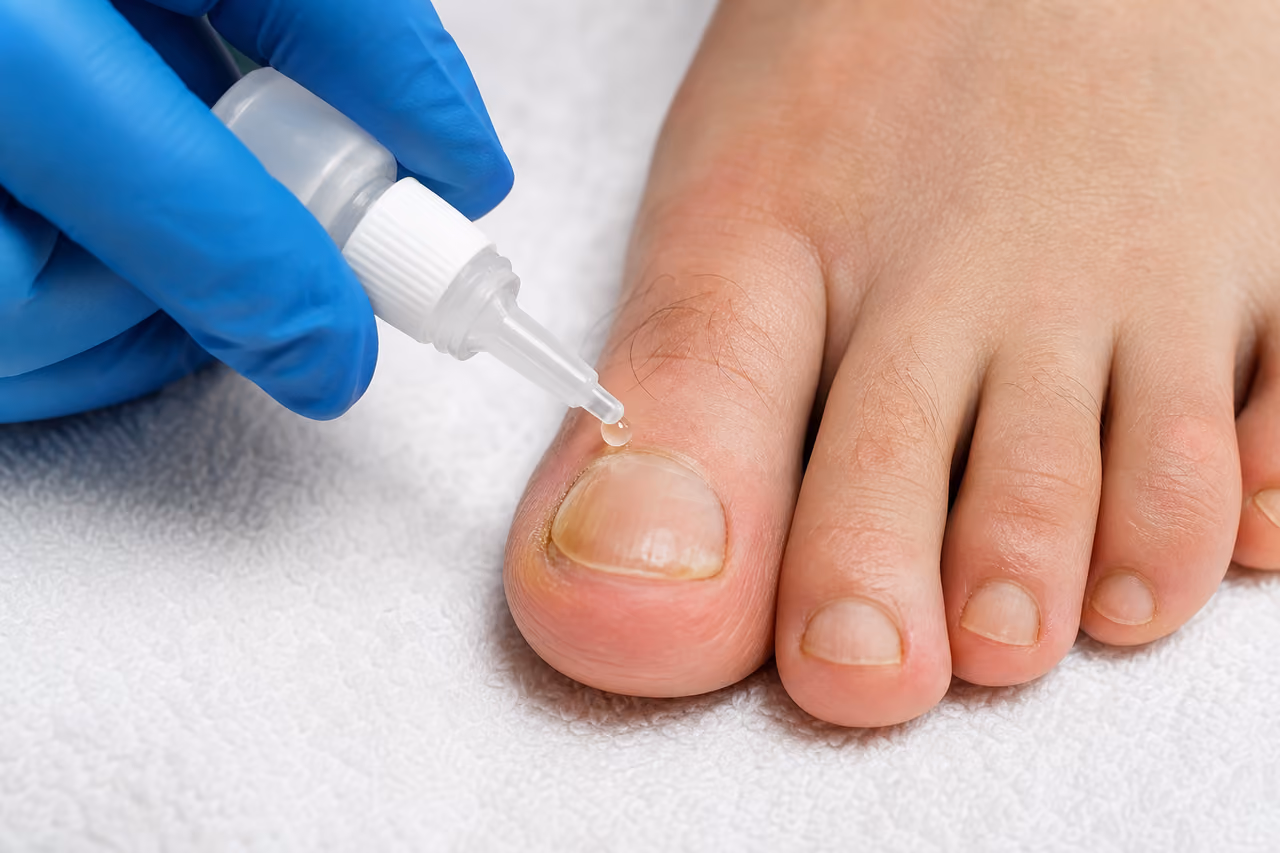 Podiatrist Applying Antifungal Medication to a Toenail