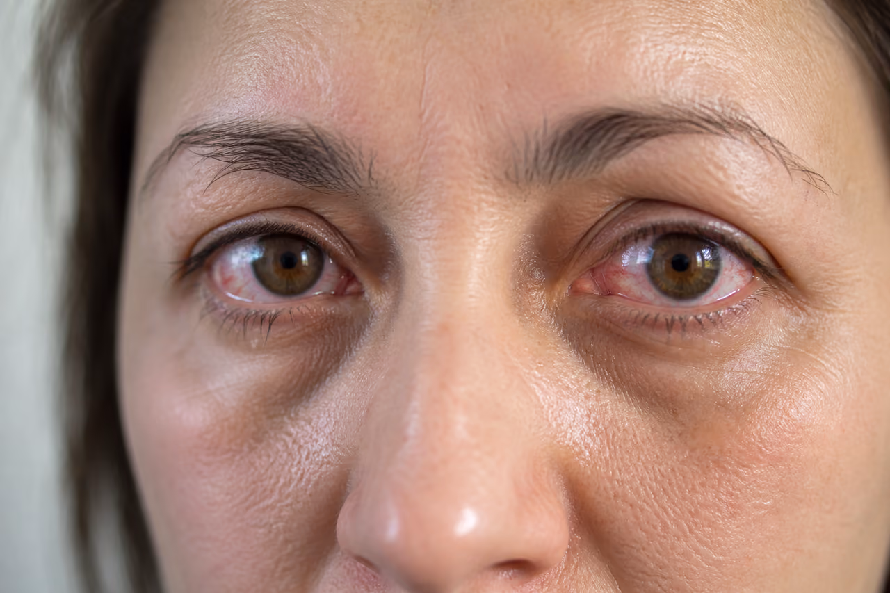 Close-Up of Inflamed Eyes Showing Sjogren's Syndrome Symptoms
