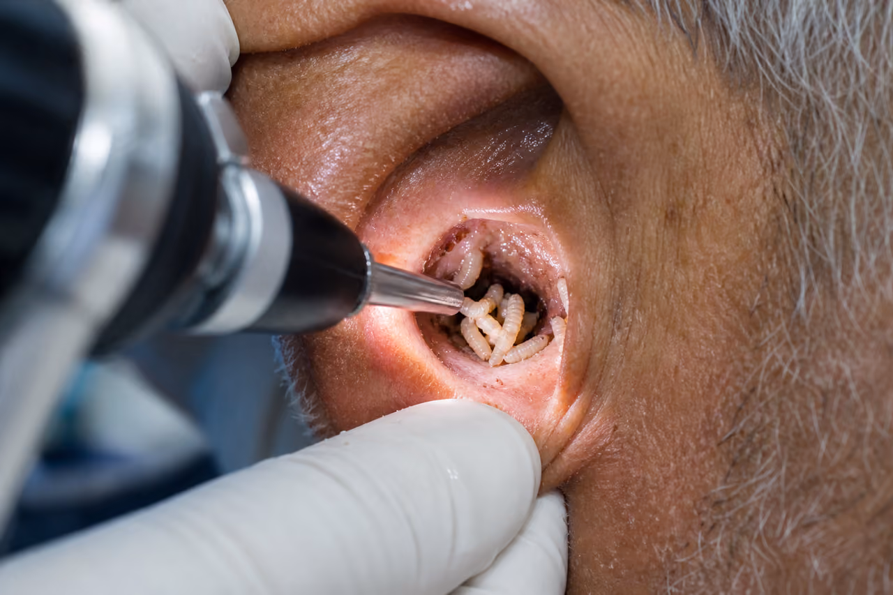 Medical Professional Examining Maggots in Ear Canal