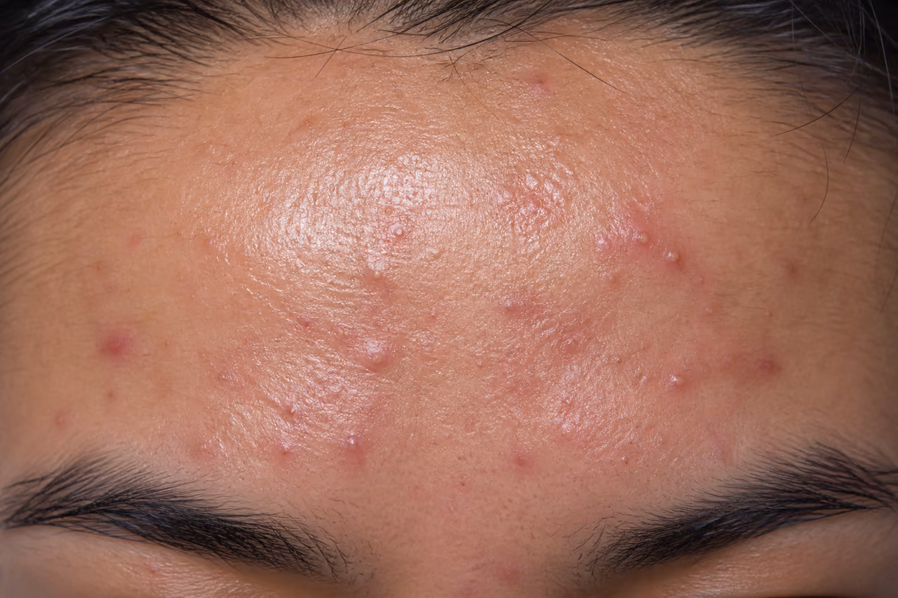Close Up of Oily Forehead Acne on Human Skin
