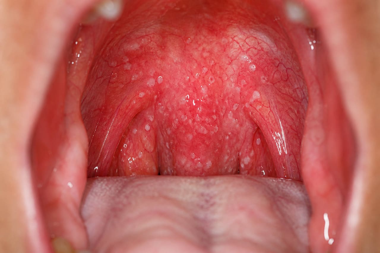 Inflamed Throat with Exudate Following a Tonsillectomy