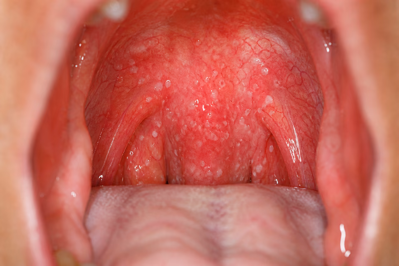 Inflamed Throat with Exudate Following a Tonsillectomy